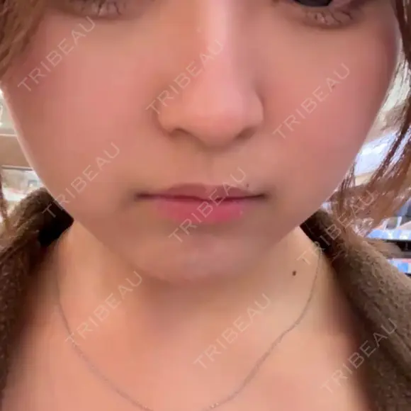 ヒアルロン酸注入（あご） DMTC CLINIC 渋谷院 BEFORE メイン用