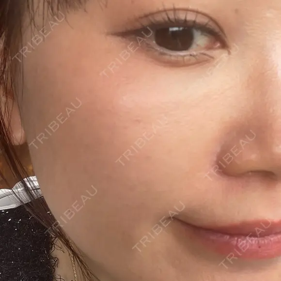 肌育注射（ジュベルックなど） 城本クリニック 立川院 BEFORE メイン用