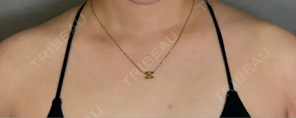ボトックス（肩） APスキンクリニック銀座 BEFORE メイン用