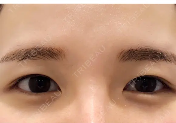 二重埋没 たにまちクリニック BEFORE メイン用