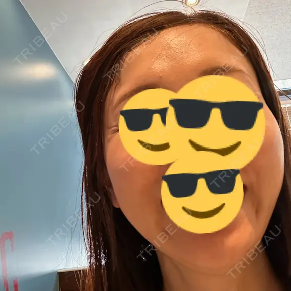 水光注射（ハリ・美肌） Chloe Cheongdam Clinic （クロエチョンダムクリニック） BEFORE メイン用