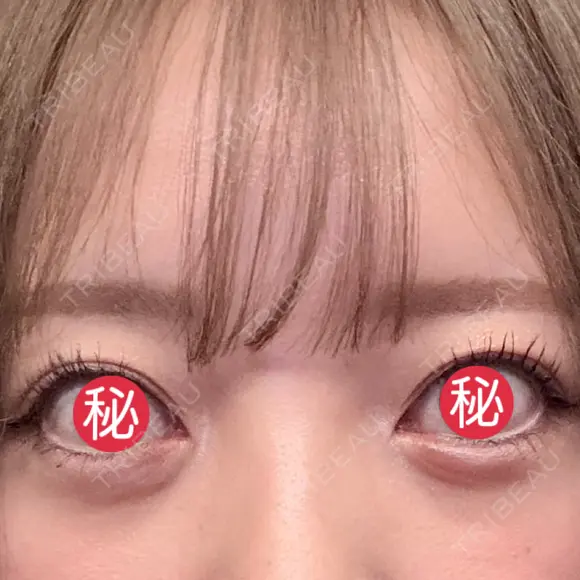 眉下切開 表参道ウィズ・クリニック BEFORE メイン用