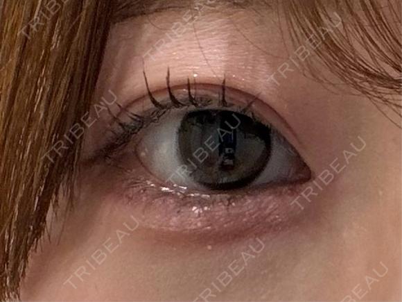 ヒアルロン酸注入（涙袋） / ヒアルロン酸注入（唇） ziz CLINIC BEFORE メイン用
