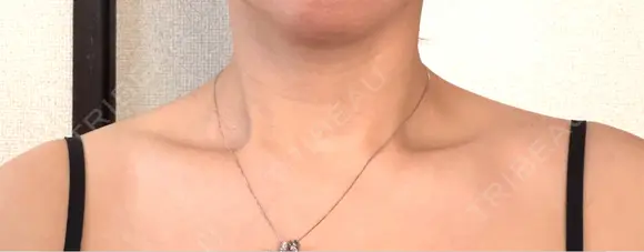 ボトックス（肩） / ワキ汗治療（ボトックス） Tokyo Tensei Clinic 銀座院 BEFORE メイン用