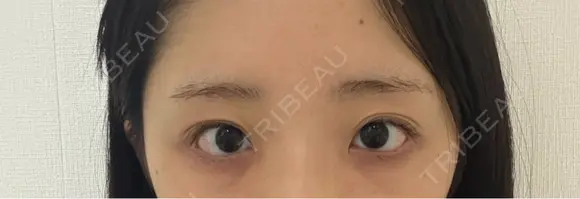 目頭切開 聖心美容クリニック 福岡院 BEFORE メイン用