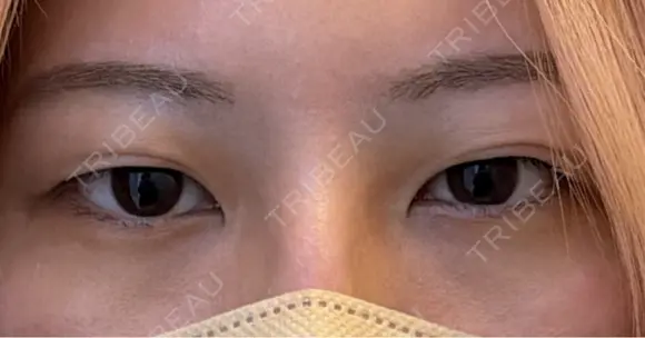 二重切開 / 眼瞼下垂（切開） eクリニック 大阪院 BEFORE メイン用