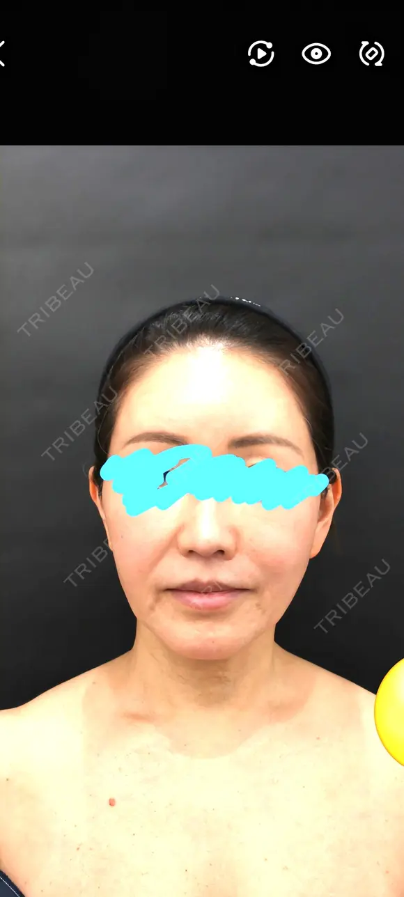 その他（輪郭） / ボトックス（エラ・小顔） / ボトックス（額） WOM CLINIC GINZA （ワム クリニック ギンザ） BEFORE メイン用