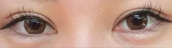 目尻切開 ララ整形外科 BEFORE メイン用