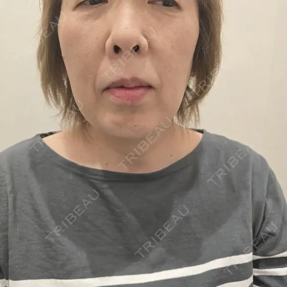 糸リフト / その他（輪郭） アリエル美容クリニック 水戸院 BEFORE メイン用