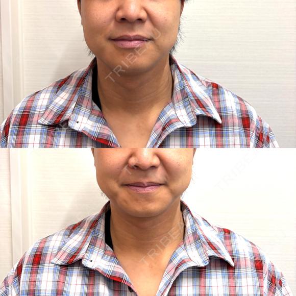 糸リフト / バッカルファット除去 / ボトックス（エラ・小顔） ルラ美容クリニック 札幌大通り院 BEFORE メイン用