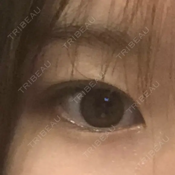 ヒアルロン酸注入（涙袋） the way（ザウェイ）整形外科 BEFORE メイン用