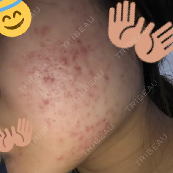 ピーリング（ニキビ・毛穴） / イオン導入 / エレクトロポレーション 湘南美容クリニック 宇都宮院 BEFORE メイン用