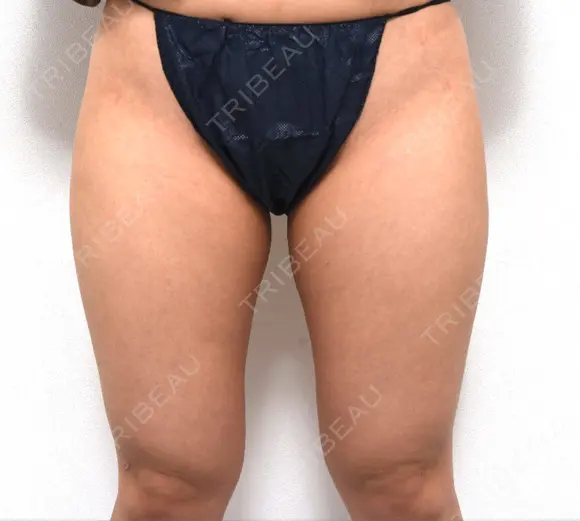 脂肪吸引（脚） / 脂肪吸引（お尻） ドクターフィット（Dr.fit）クリニック BEFORE メイン用