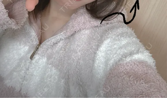 ボトックス（肩） APスキンクリニック銀座 BEFORE メイン用