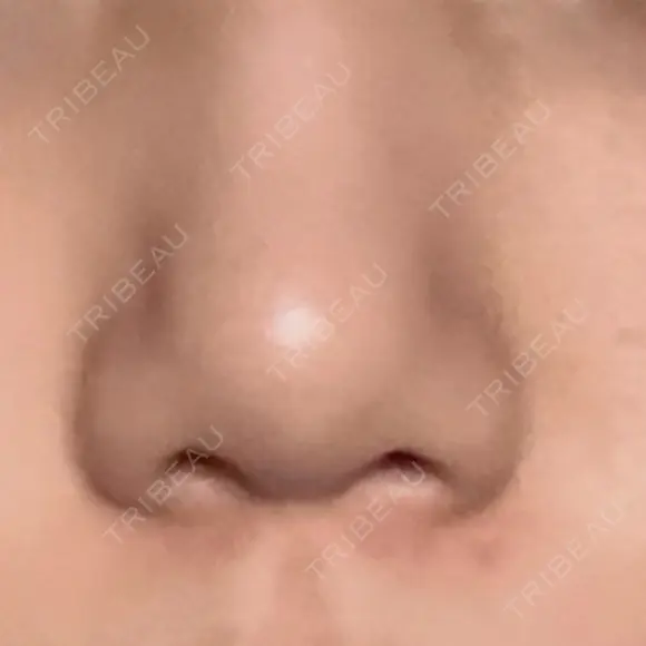 目頭切開 / 鼻尖形成（切開） / 軟骨移植 R Beauty CLINIC 銀座院 BEFORE メイン用