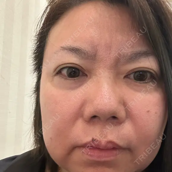 クマ治療 PRISM Beauty Clinic 町田院 BEFORE メイン用