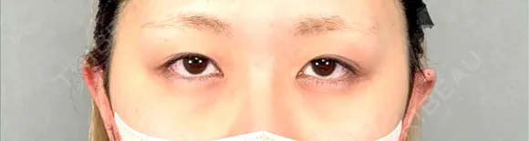 二重埋没 / 上まぶたの脂肪取り アリエル美容クリニック 大宮院 BEFORE メイン用