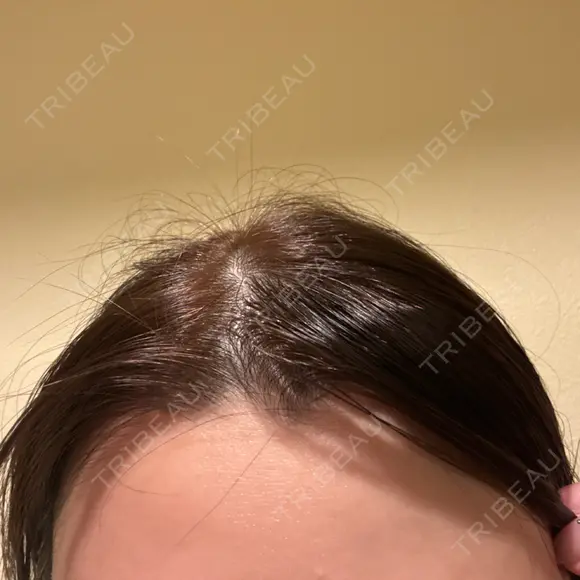 多汗症治療（ボトックス） 筋肉・美容クリニック BEFORE メイン用