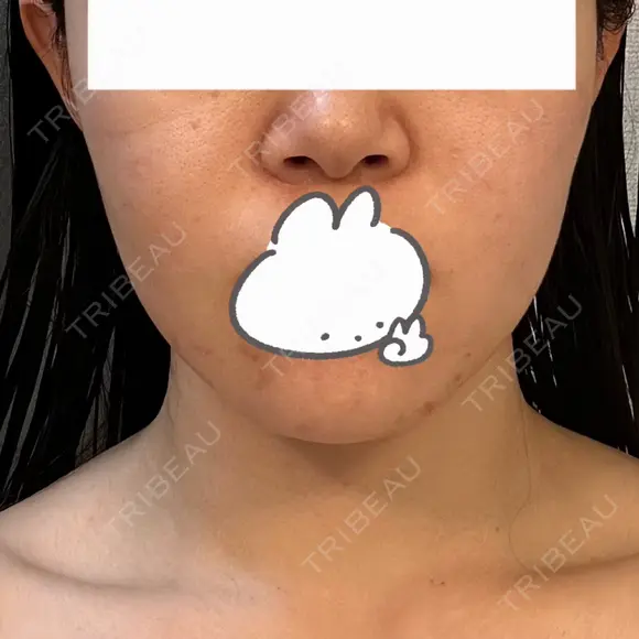 インモード PureMe Skin Clinic（ピュアミースキンクリニック麻布） BEFORE メイン用
