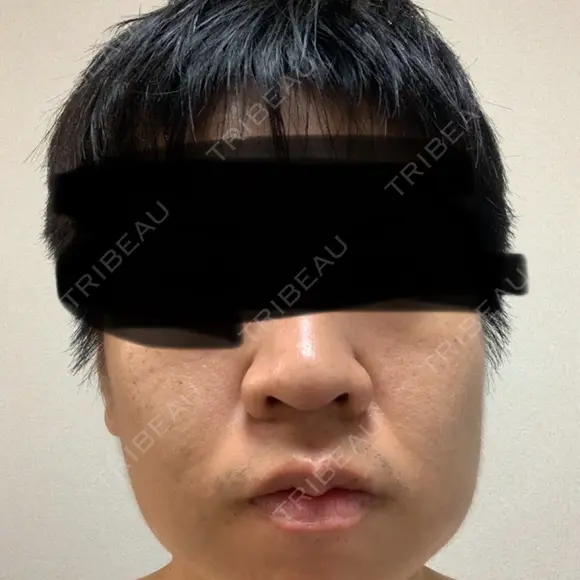 糸リフト / バッカルファット除去 / 脂肪吸引（顔） / ジョールファット除去 / 脂肪吸引注射（顔） SEA CLINIC（シークリニック） BEFORE メイン用
