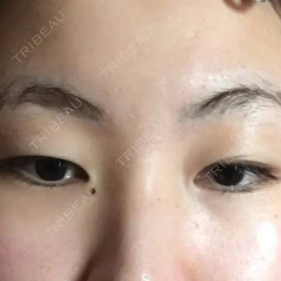 二重埋没 / 目頭切開 / 上まぶたの脂肪取り 湘南美容クリニック 京都院 BEFORE メイン用