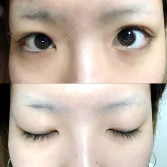 二重切開 / 上まぶたの脂肪取り TCB東京中央美容外科 江坂院 BEFORE メイン用