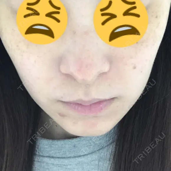 YAGレーザー 仁愛クリニック BEFORE メイン用