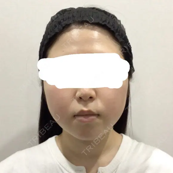 糸リフト / バッカルファット除去 / 脂肪吸引（顔） / ネックリフト / ヒアルロン酸注入（あご） / ボトックス（エラ・小顔） / ヒアルロン酸注入（唇） / ヒアルロン酸注入（鼻翼基部） / ヒアルロン酸注入（ほうれい線） HAAB×DREAM BEAUTY CLINIC 東京本院 BEFORE メイン用