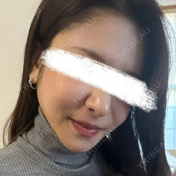 脂肪注入（額） 4Dクリニック BEFORE メイン用