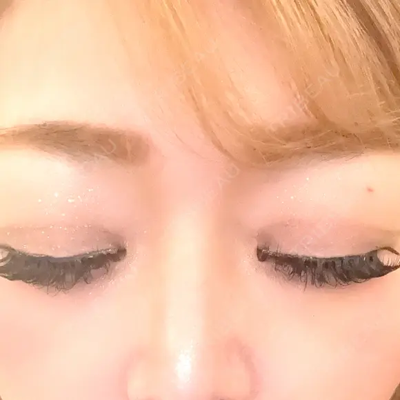 ボトックス（あご） / ボトックス（眉間） / ボトックス（目尻） / ボトックス（額） / ボトックス（バニーライン） 湘南美容クリニック 名古屋院 BEFORE メイン用
