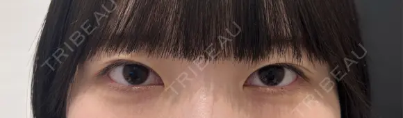 二重埋没 R Beauty CLINIC 名古屋院 BEFORE メイン用