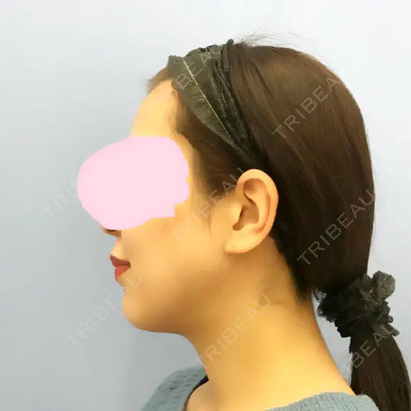 ボトックス（エラ・小顔） 湘南美容クリニック 秋葉原院 BEFORE メイン用