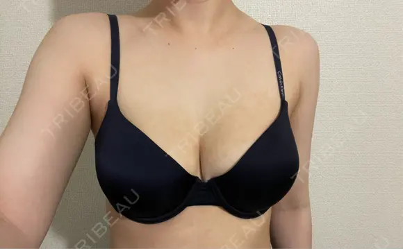 脂肪吸引（二の腕） / 豊胸（脂肪注入） / 脂肪吸引（肩） Lipo Clinic omotesando BEFORE メイン用