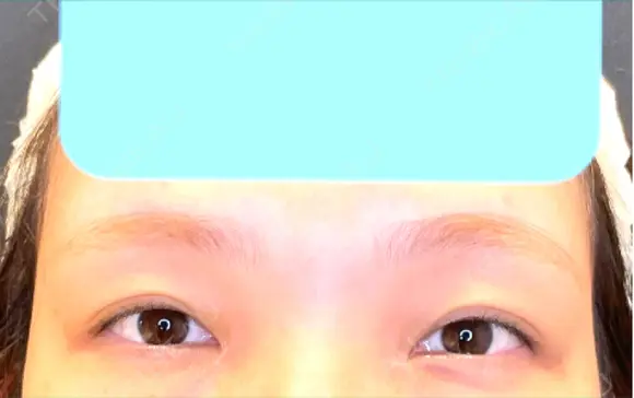 目尻切開 / タレ目形成・グラマラスライン（埋没） LOUIS CLINIC 二子玉川院【ルイクリニック】 BEFORE メイン用