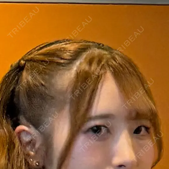 下まぶたの脂肪取り 聖心美容クリニック 福岡院 BEFORE メイン用