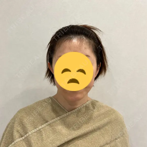 切開リフト GRACY TOKYO CLINIC【グレイシートウキョウクリニック】 BEFORE メイン用