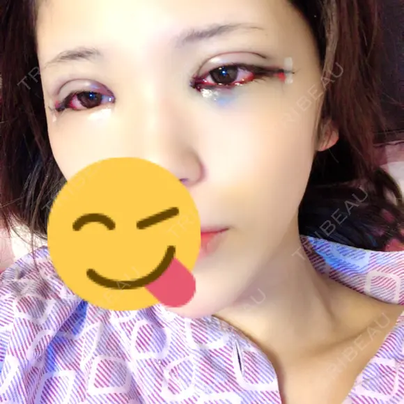 二重埋没 / 目頭切開 / 目尻切開 RG整形外科（旧リオン整形外科） BEFORE メイン用