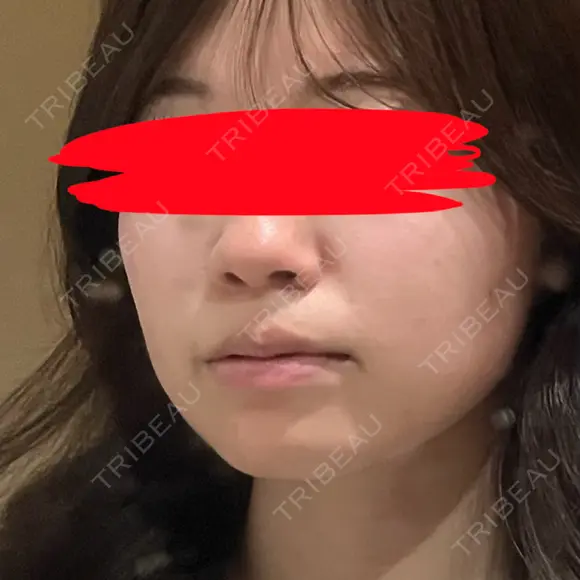 糸リフト / 脂肪吸引（顔） / 脂肪吸引注射（顔） SEA CLINIC（シークリニック） BEFORE メイン用