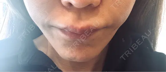 切開リフト GRACY TOKYO CLINIC【グレイシートウキョウクリニック】 BEFORE メイン用