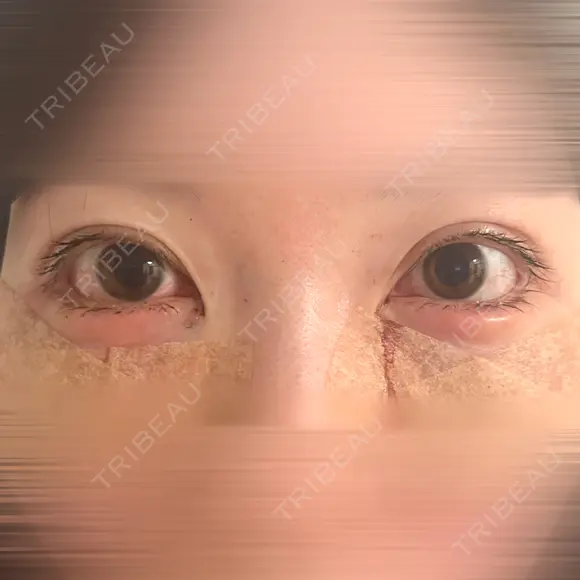 その他（目元） / クマ治療 WOM CLINIC GINZA （ワム クリニック ギンザ） BEFORE メイン用