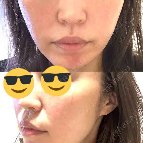 RF（高周波）たるみ治療 / オリジオ muni skin clinic BEFORE メイン用