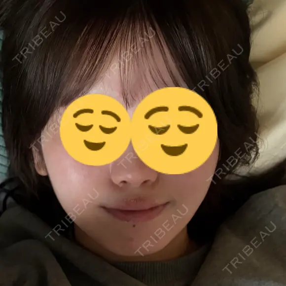 ハイフ（顔） HAAB×DREAM BEAUTY CLINIC 大阪梅田院 BEFORE メイン用