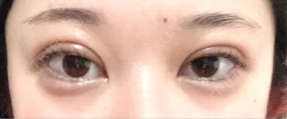 アートメイク（眉） G MEDICAL ART クリニック 新宿院 BEFORE メイン用
