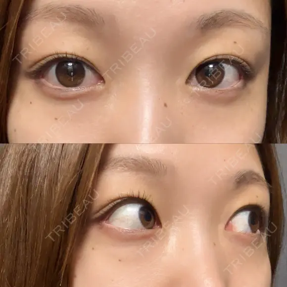 下まぶたの脂肪取り / 眉下切開 / ボトックス（額） 表参道ウィズ・クリニック BEFORE メイン用