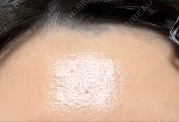 医療脱毛（顔） Jスキンクリニック 【J-SKIN clinic】 BEFORE メイン用