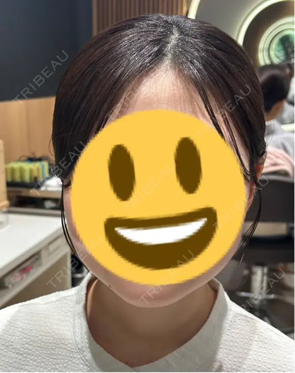 ボトックス（エラ・小顔） / ボトックス（眉間） / ボトックス（額） ルラ美容クリニック 大阪心斎橋院 BEFORE メイン用