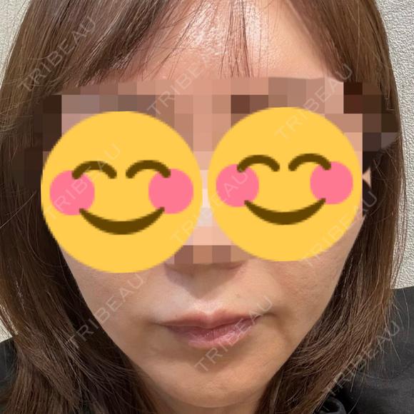 糸リフト / 脂肪吸引（顔） / ジョールファット除去 / 脂肪吸引注射（顔） / ヒアルロン酸注入（涙袋） / ヒアルロン酸注入（唇） ziz CLINIC BEFORE メイン用