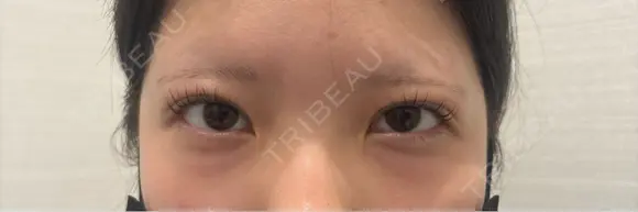 クマ治療 R Beauty CLINIC 名古屋院 BEFORE メイン用