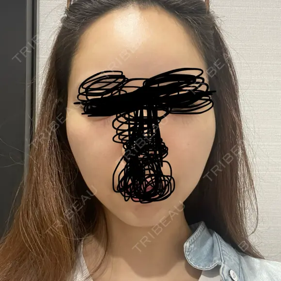 メーラーファット除去 / ジョールファット除去 R Beauty CLINIC 名古屋院 BEFORE メイン用