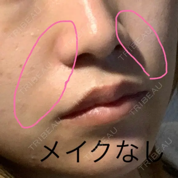 肌ヒアルロン酸注入（たるみ・シワ改善） / その他（肌） フィラークリニック 新宿院 BEFORE メイン用